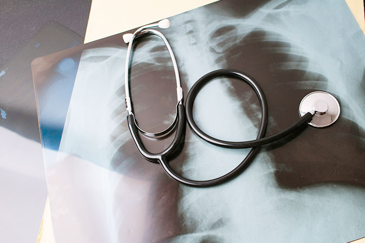 胸部レントゲン検査のイメージ